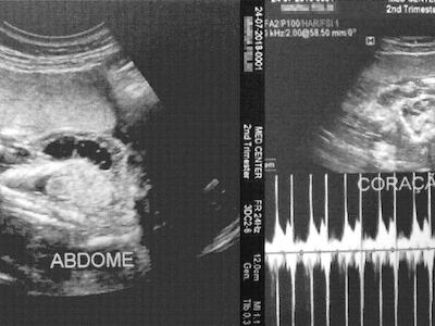 Um aborto a cada quatro grávidas