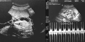 Um aborto a cada quatro grávidas Um aborto a cada quatro grávidas