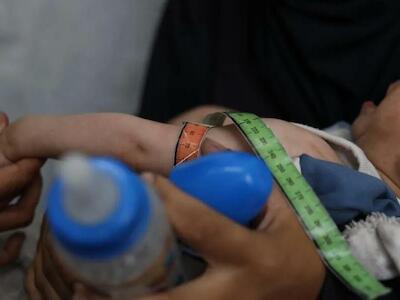 - Un bebé palestino que padece desnutrición, siendo atendido en la clínica de MSF en la ciudad de Gaza. 4 de junio de 2025. © Nour Alsaqqa/MSF